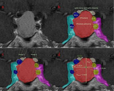 A clinical practical model for preoperative prediction of visual outcome for pituitary adenoma patients in a retrospective and prospective study